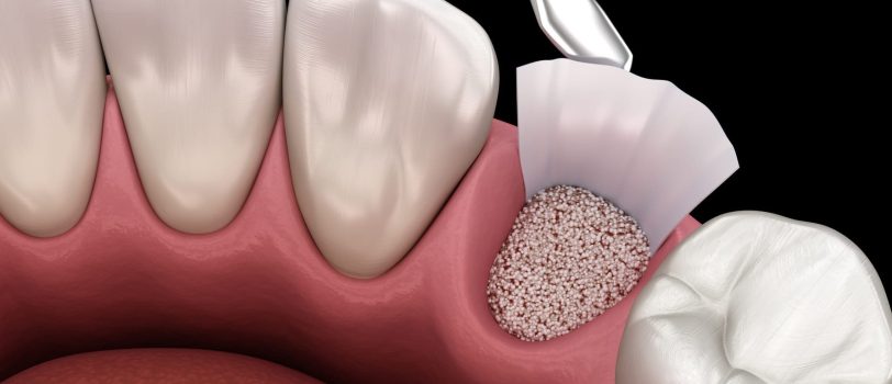 header-bone-grafting_1 header-bone-grafting_1